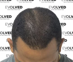 Male Patient Look Before Hair Transplant