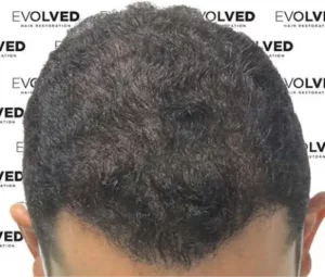 Male Patient Look After Hair Transplant