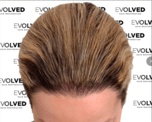 Evolved Patient Look After Hair Transplant