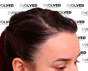 Female Patient Look After Hair Transplant