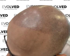 Male Patient Look After Hair Transplant