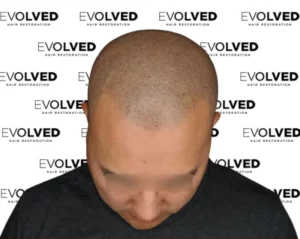 Male Patient Look Before Hair Transplant