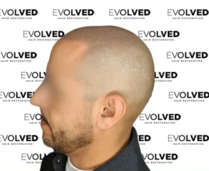 Male Patient Look Before Hair Transplant