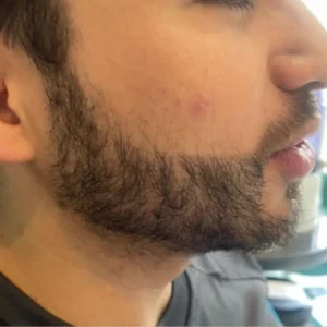 Male Patient Look Before Beard Transplant