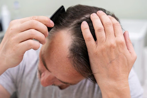 bald no more