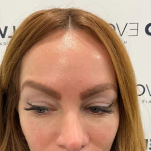 Female Patient Look After Eyebrow Transplant