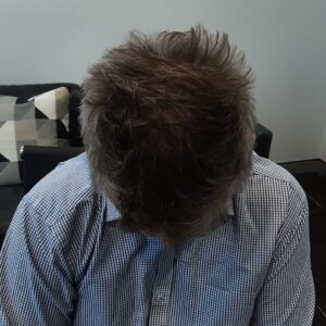 Male Patient Look After Hair Transplant