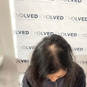 Female Patient Look Before Hair Transplant
