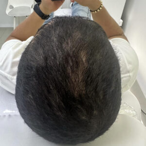 Male Patient Look After Hair Transplant