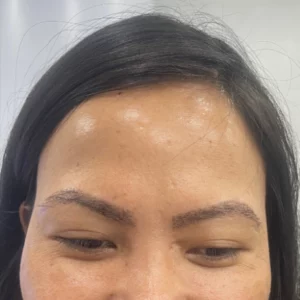 Female Patient Look Before Eyebrow Transplant