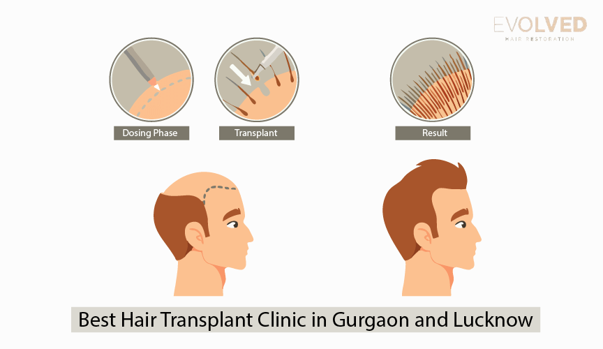 Best Hair Transplant Clinic in Gurgaon and Lucknow