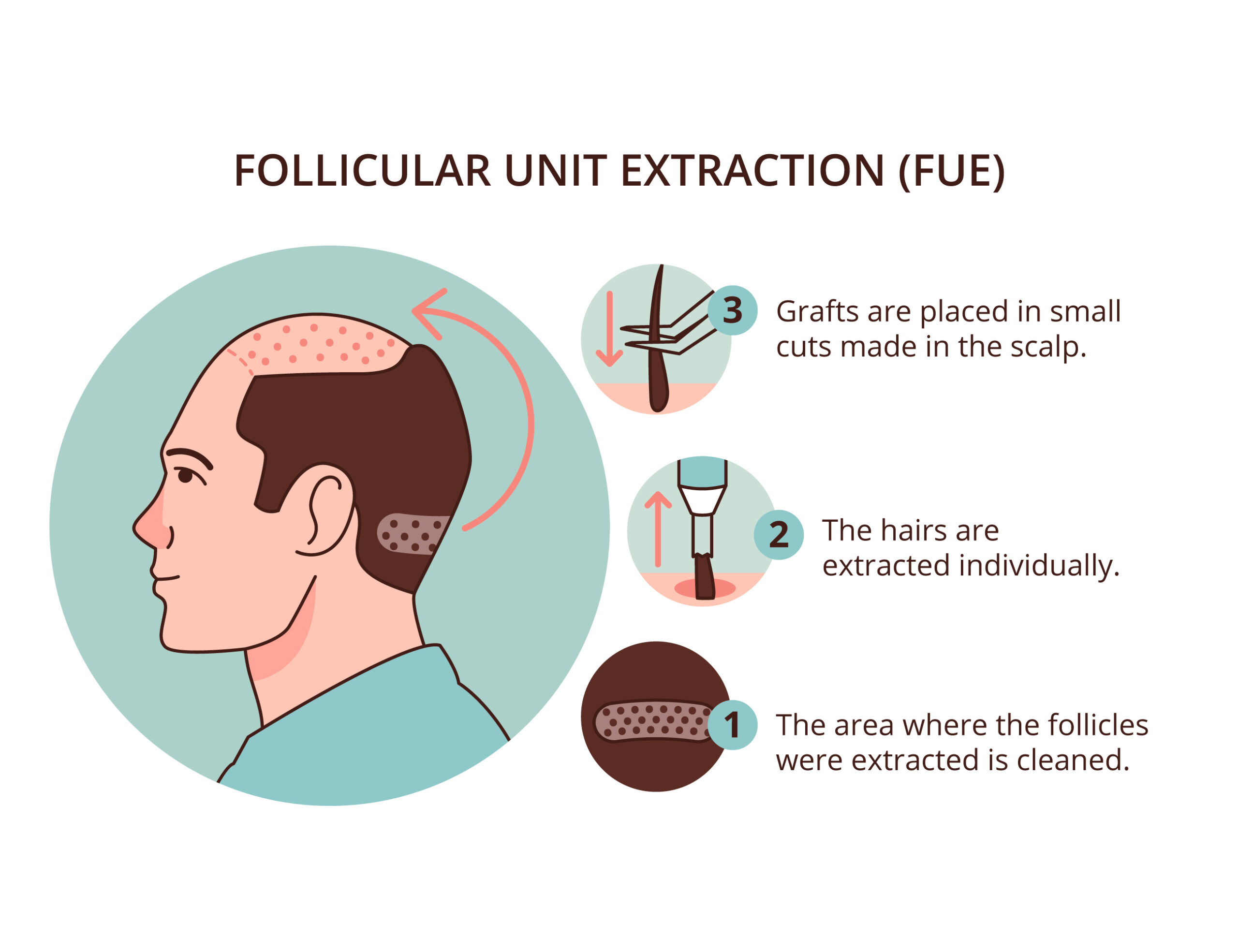 hair transplant
