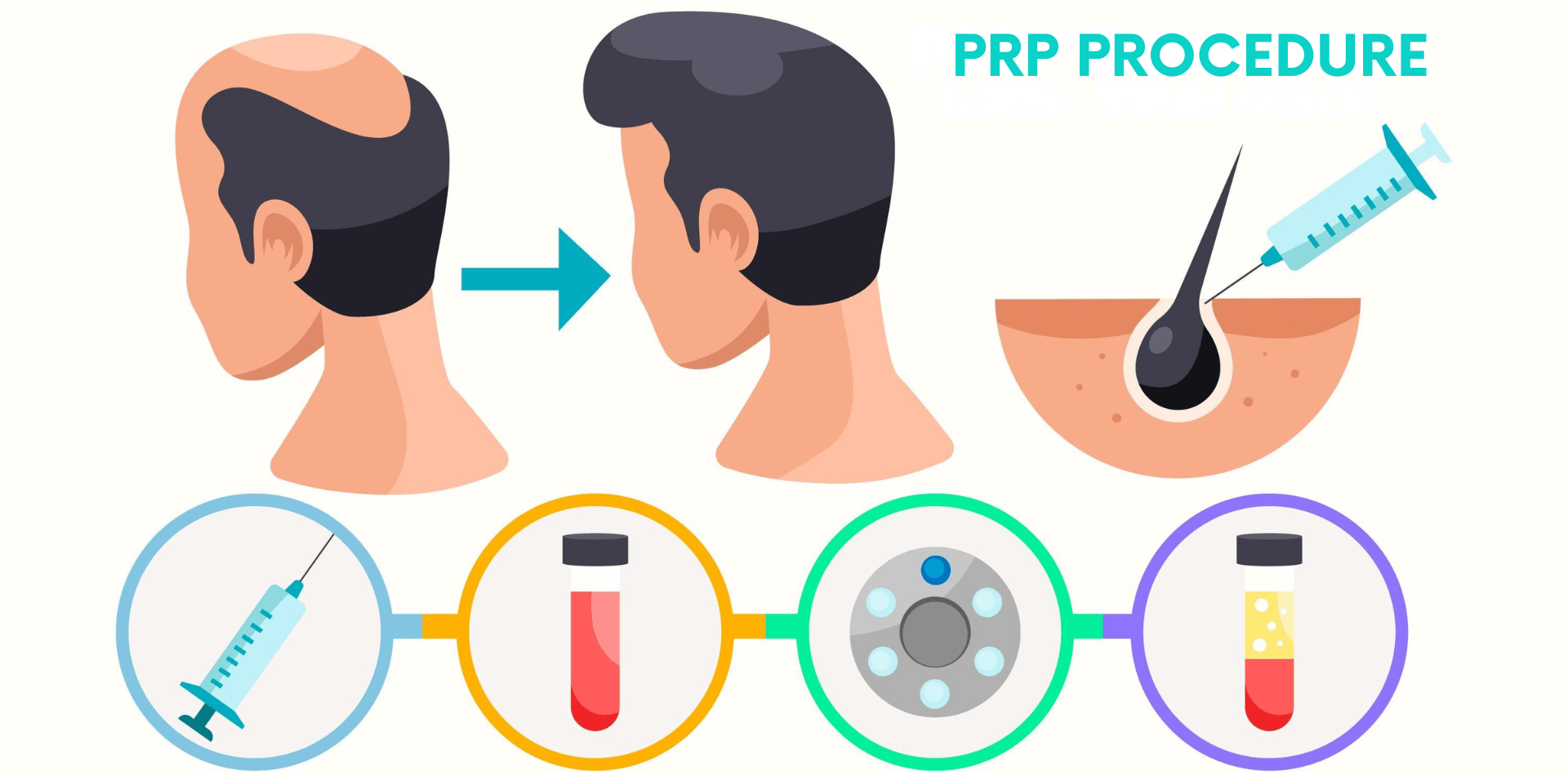 PRP hair treatment in Gurgaon for early-stage hair loss