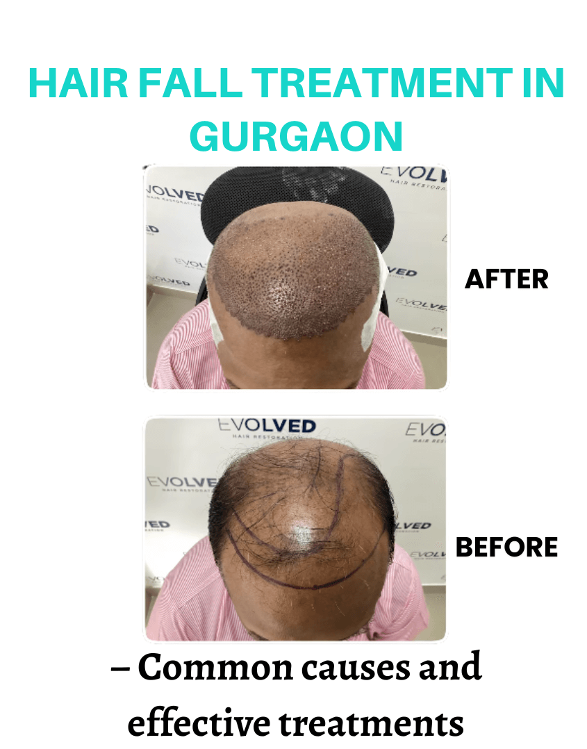 Hair fall treatment in gurgaon