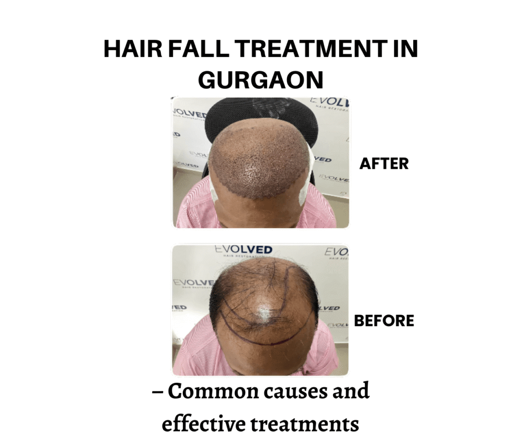 Hair fall treatment in gurgaon