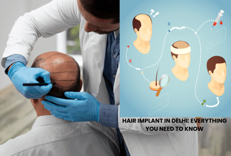 Hair Implant in Delhi