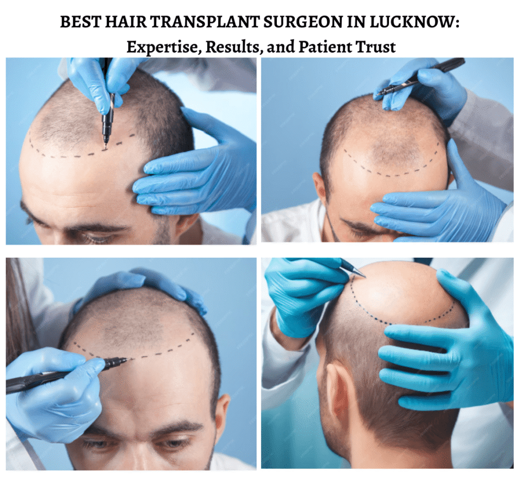 Best Hair Transplant Surgeon in Lucknow