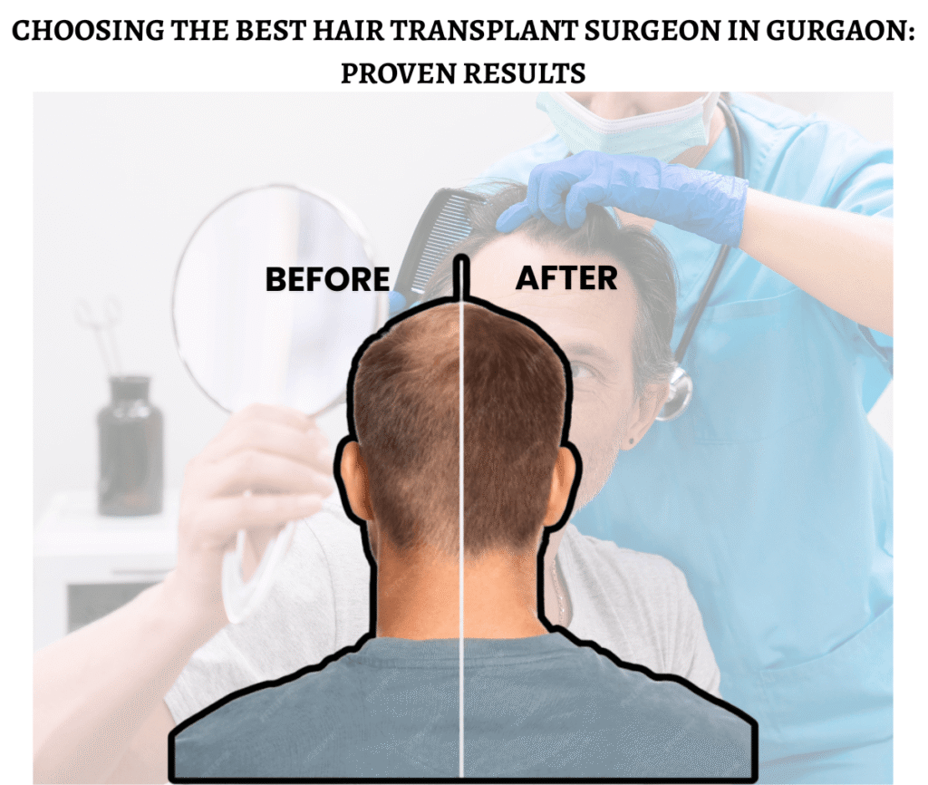 best hair transplant surgeon Gurgaon